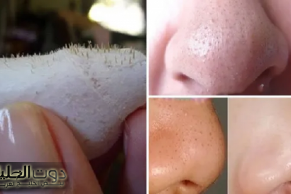 وصفه مبهره.. انسي البثور والبقع السوداء مقشر النشا والخل في ثواني هتكونى ملكة جمال