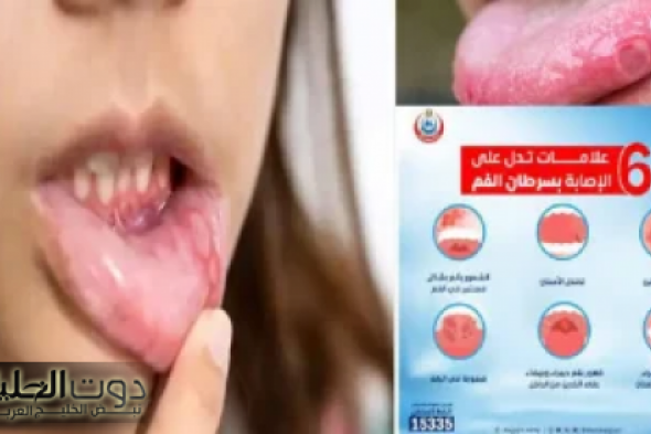 يتجاهلها كثيرون.. طبيب أسنان يكشف 7 علامات تحذيرية مبكرة لسرطان الفم خلي بالك منها الموضوع مافيهوش هزار حياتك في خطر!!!