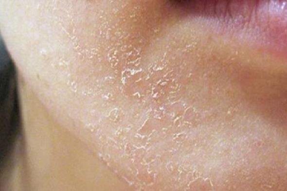 تجنبيها .. عادات خاطئة تسبب جفاف البشرة